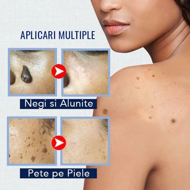 ClearSkin WartOff Cream - Eliminare Negi si Imperfectiuni Fara Durere 4