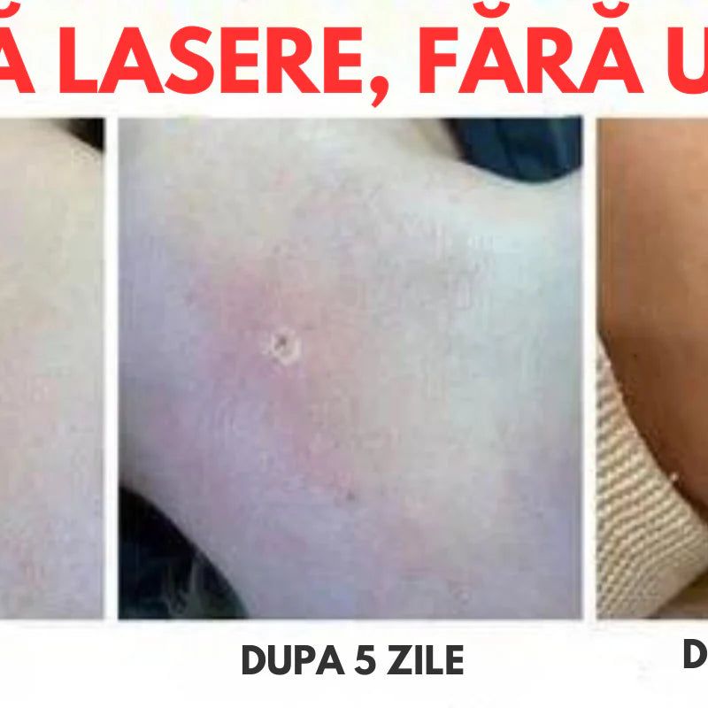 ClearSkin WartOff Cream - Eliminare Negi si Imperfectiuni Fara Durere 5