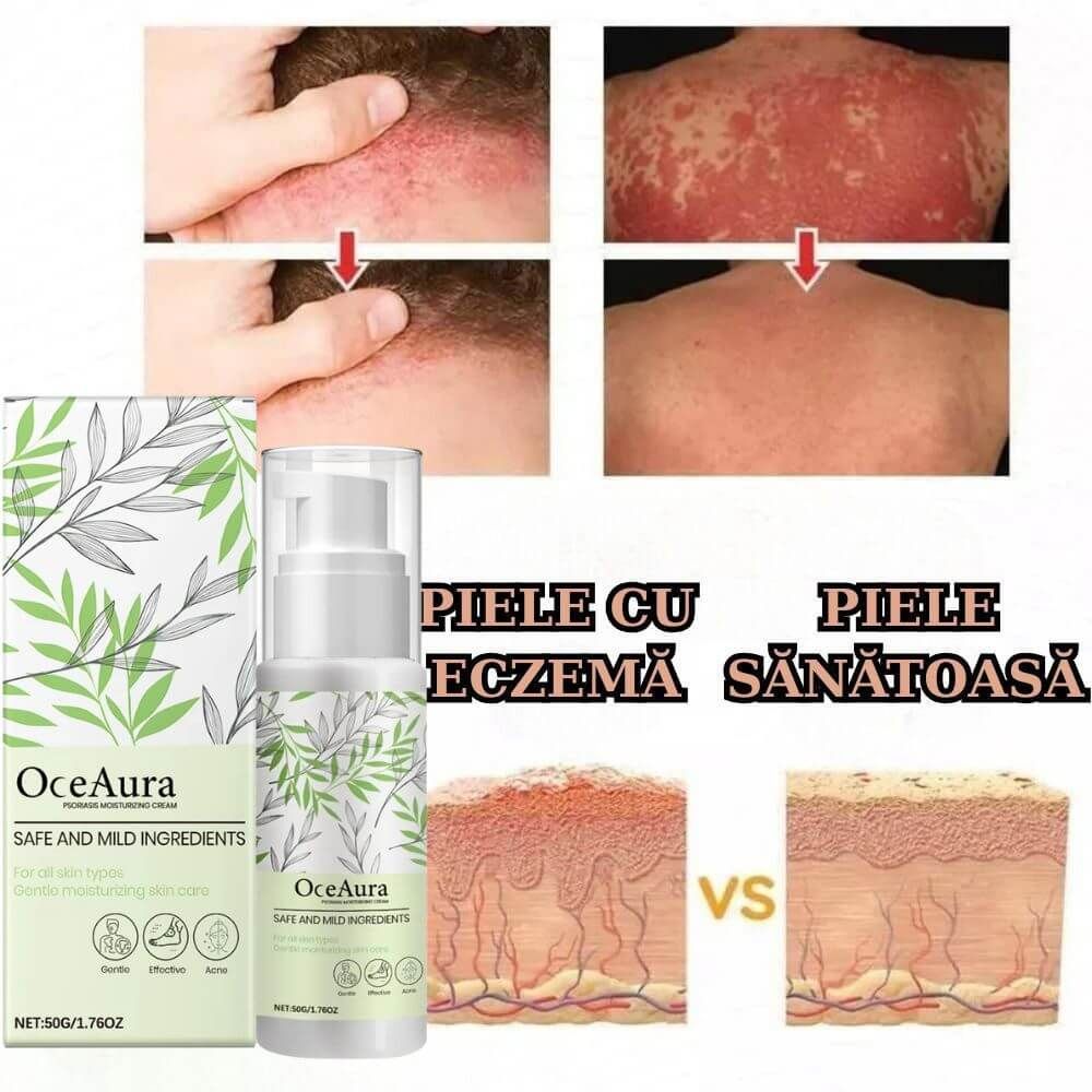 Crema Antifungica pentru Eczeme si Piele Iritata 3