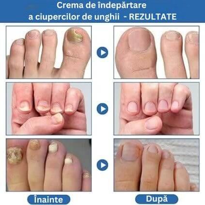 Crema de îndepărtare a ciupercilor de unghii