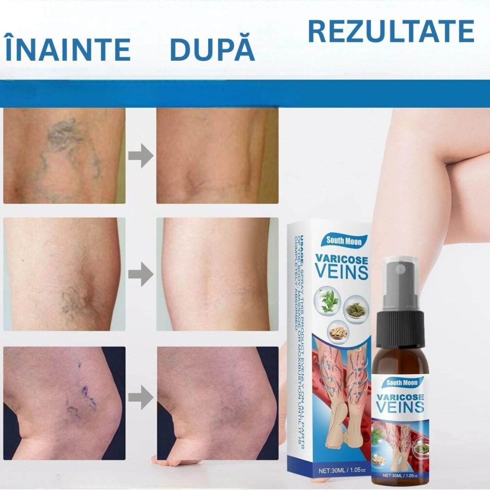 Spray pentru varice, diminuarea umflării și senzației de tensiune