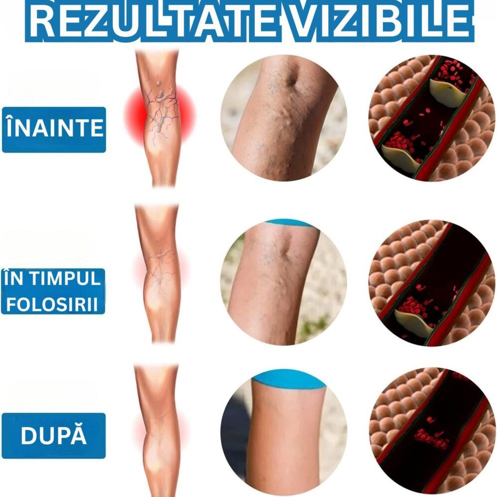 Rezultate prin utilizarea constantă a spray-ului pentru varice
