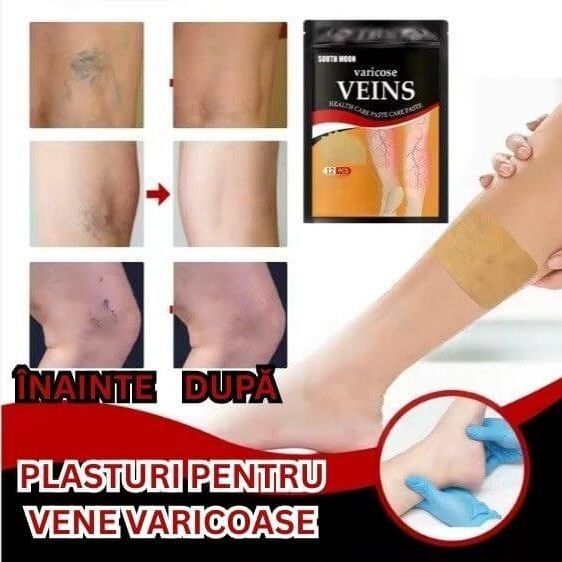 plasturii pentru vene varicoase photoroom 1
