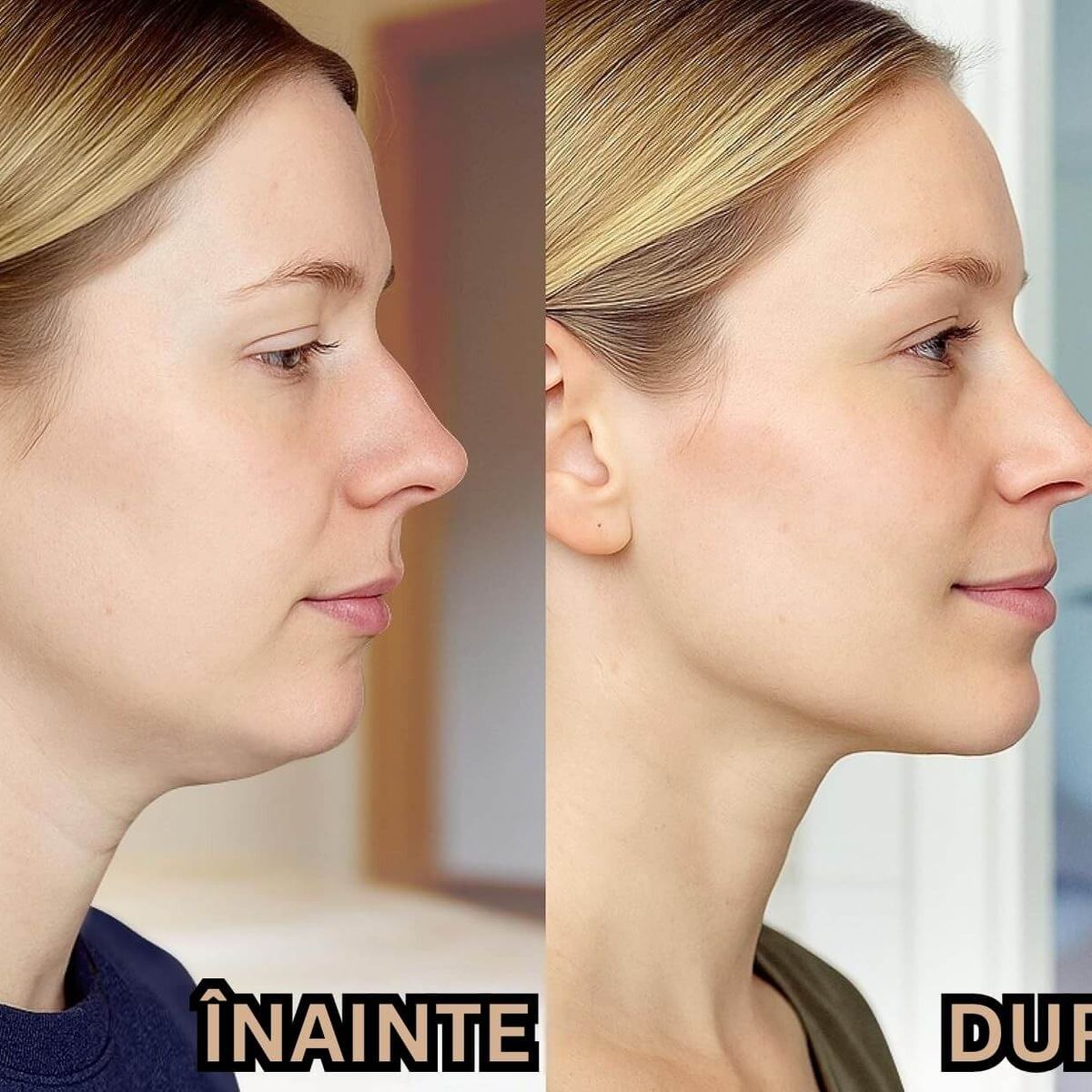 Banda pentru Lifting Facial 5