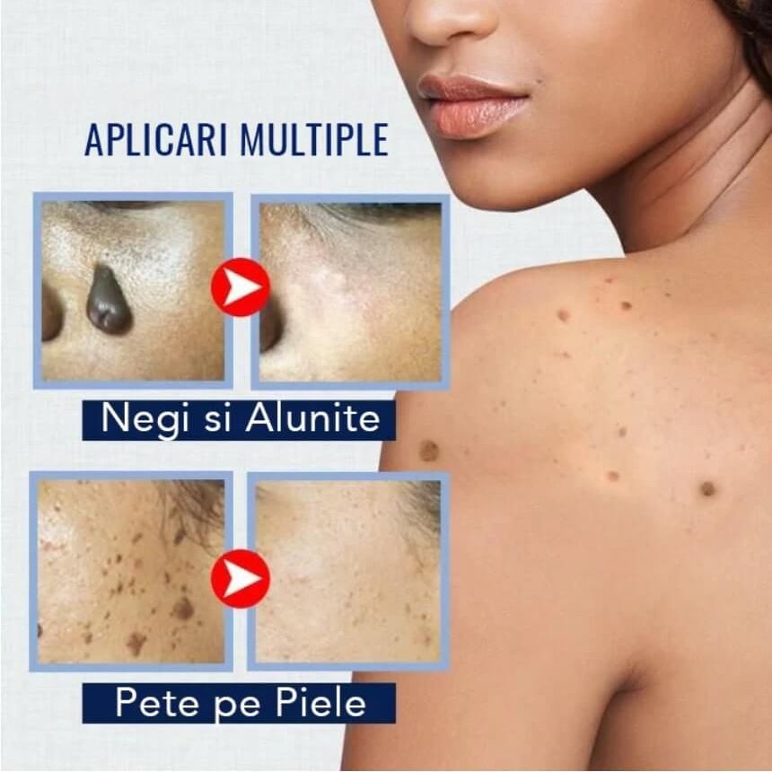 Crema Impotriva Negilor si a Pielii Pigmentate 2