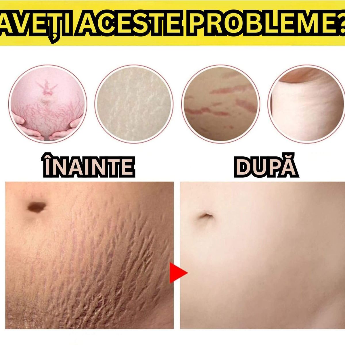 Crema pentru Vergeturi 3