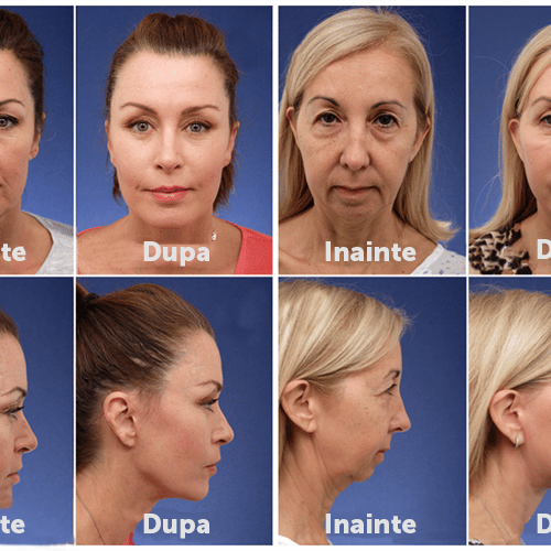 Set Plasturi Invizibili pentru Lifting Facial 7