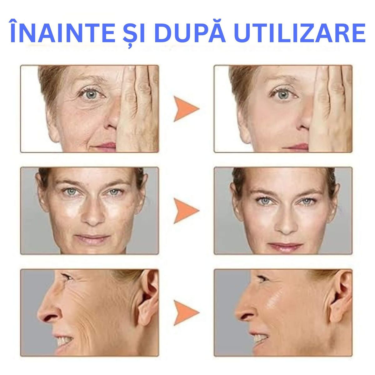 Ser cu Botox pentru Lifting Facial 3