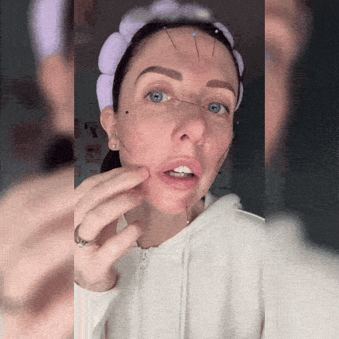 Ser Terapie Micro-needling Pori Faciali cu Vitamina B12 4