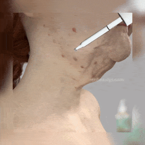 Super Ser Facial pentru Riduri 4